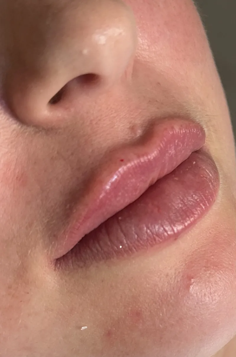 Depois do preenchimento labial